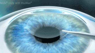 近视眼手术后的亲身经历2020,近视眼手术10年后的亲身经历