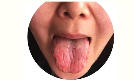 舌诊图解正常舌头是什么样的,观舌识病22种舌诊图解大全