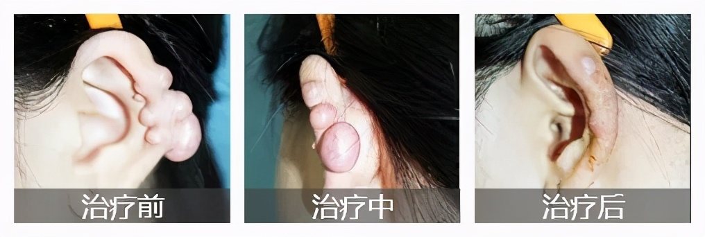 无缘无故身上长了好多疤痕疙瘩,疤痕体质身上到处疙瘩