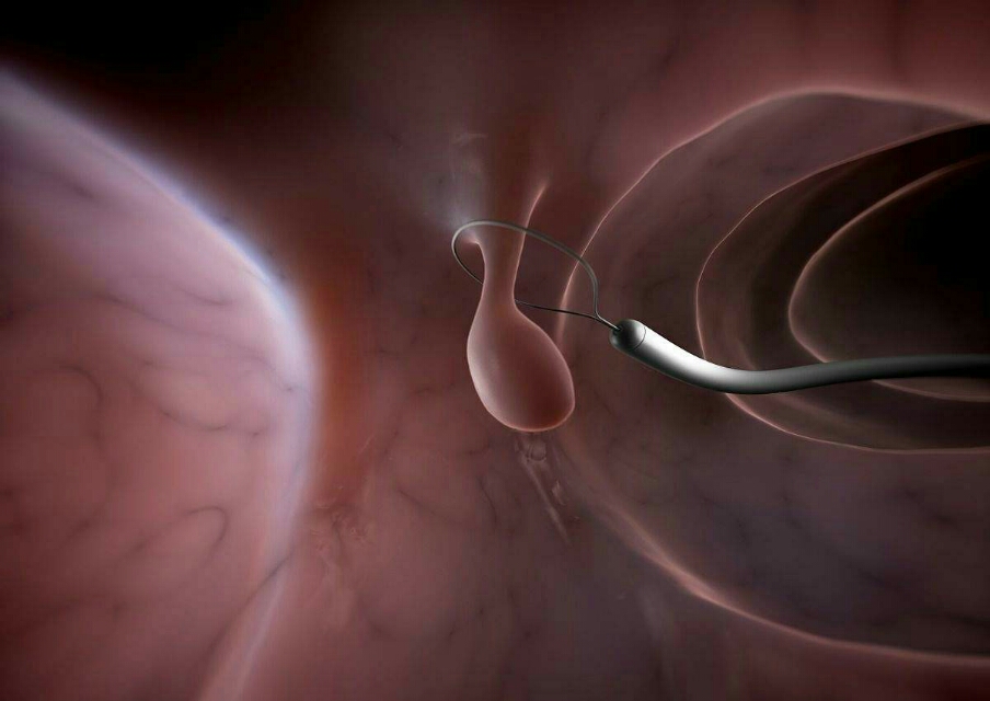 结直肠管状腺瘤、绒毛状腺瘤，要紧吗？会发展成癌吗？