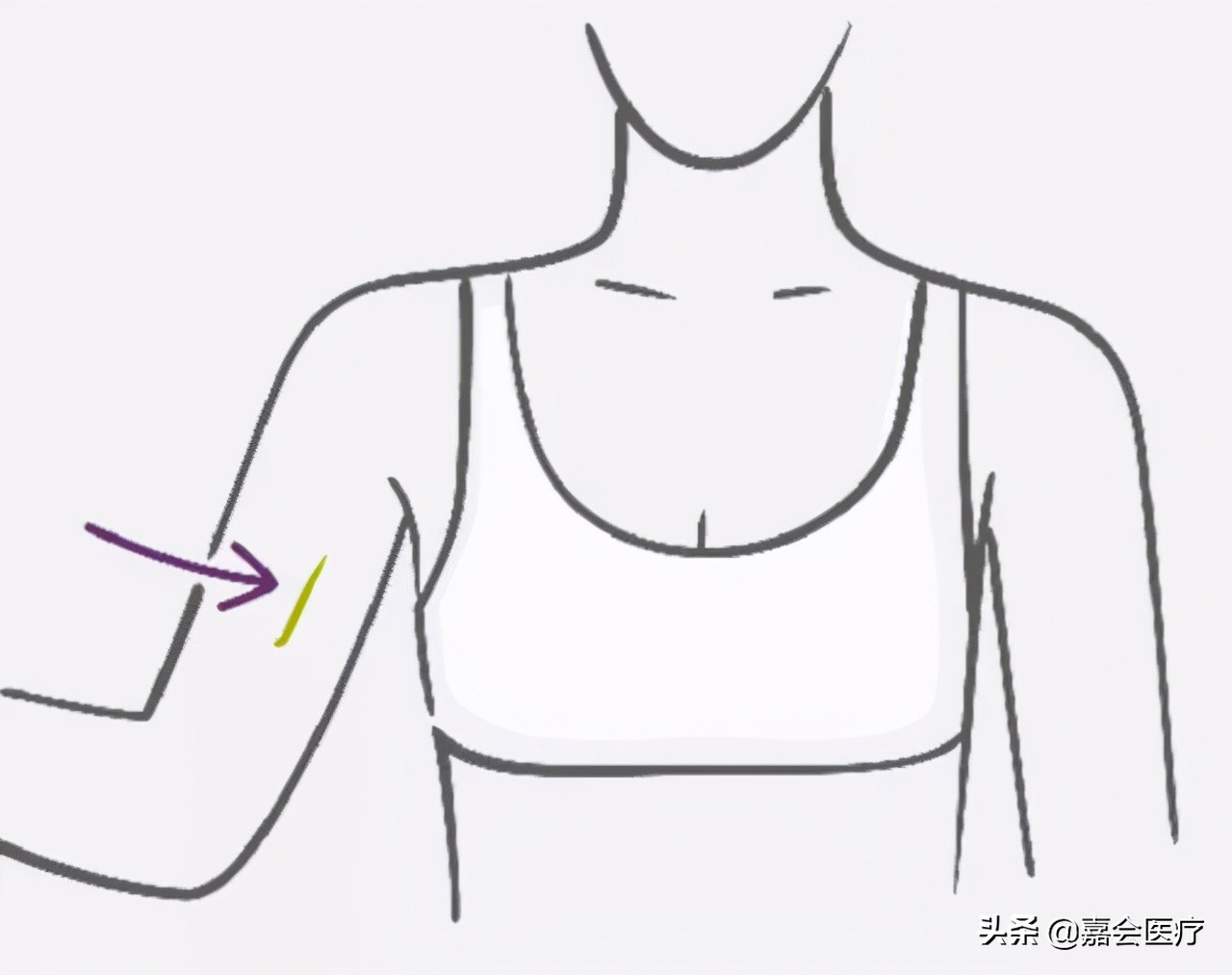 皮埋避孕可以不做避孕措施吗,想长期避孕但不结扎的办法有什么