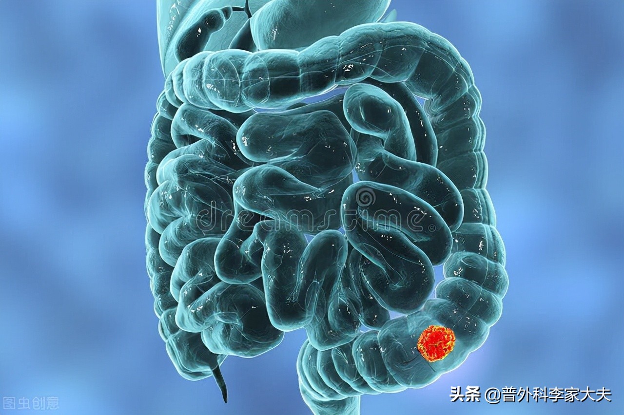 结肠癌三期还能治愈吗,结肠癌三期化疗方法