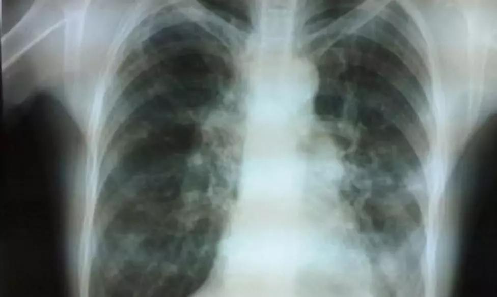 慢性气管炎最常见并发症,急性气管支气管炎主要表现症状