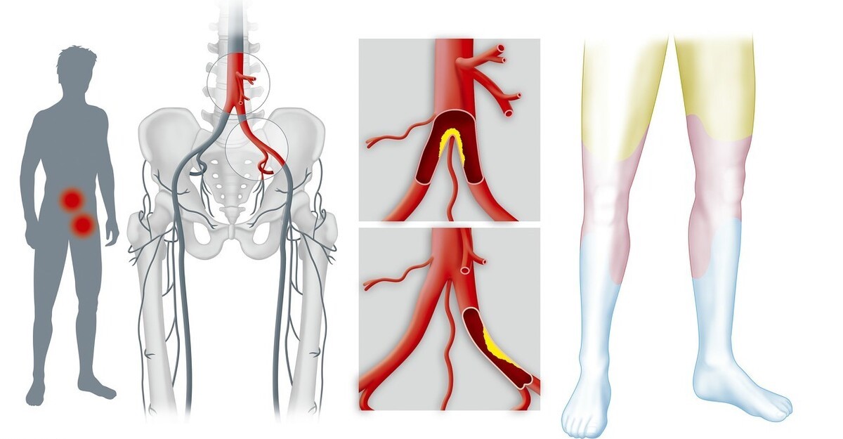 治疗腿疼的氨糖有哪些,腿疼长期吃氨糖可以吗