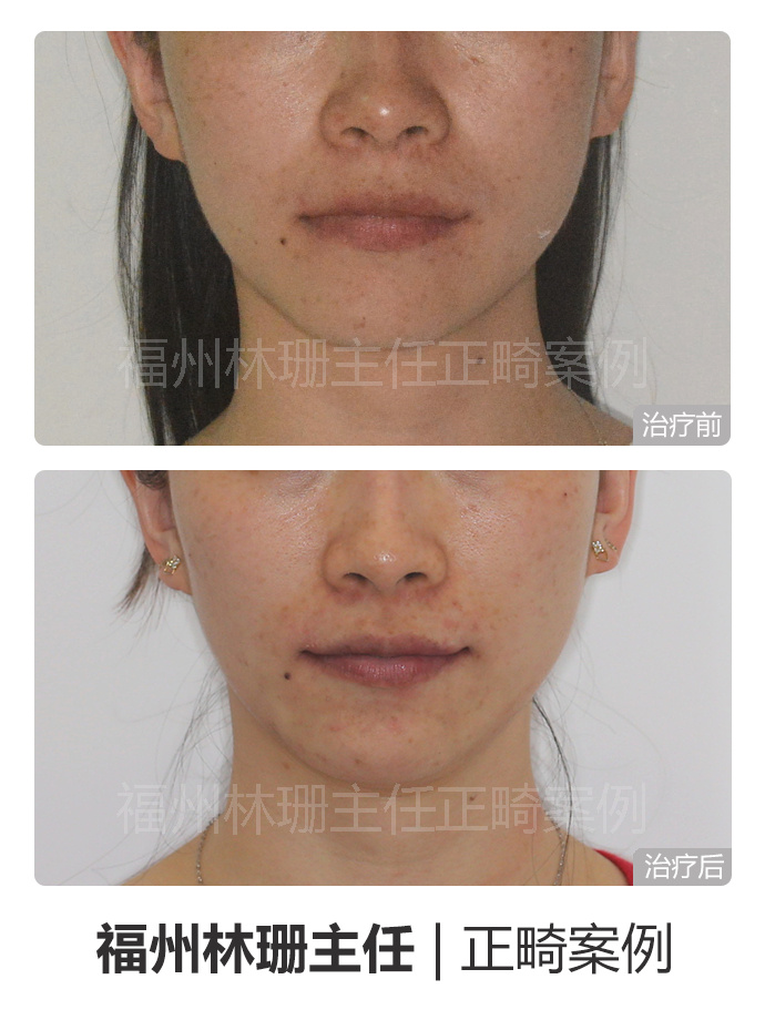 福州晋安哪里矫正牙齿,福州牙齿畸形龅牙矫正