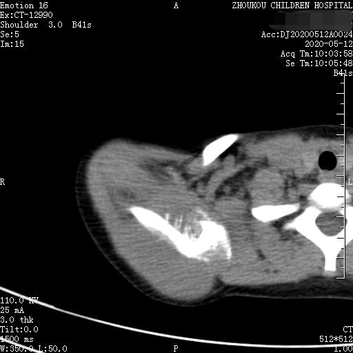 家长要警惕孩子腺样体面容,家长应该警惕孩子出现异常