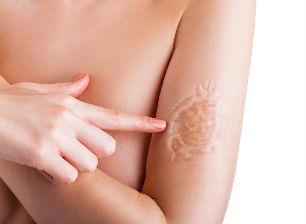 糖尿病伤疤好了有黑印怎么办,糖尿病身上的疤痕不容易好