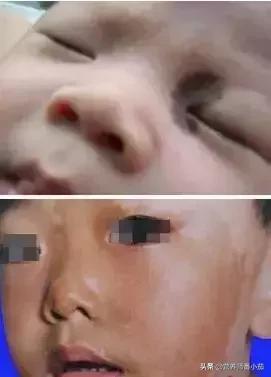 粟粒疹宝宝,宝宝红斑丘疹鉴别图谱