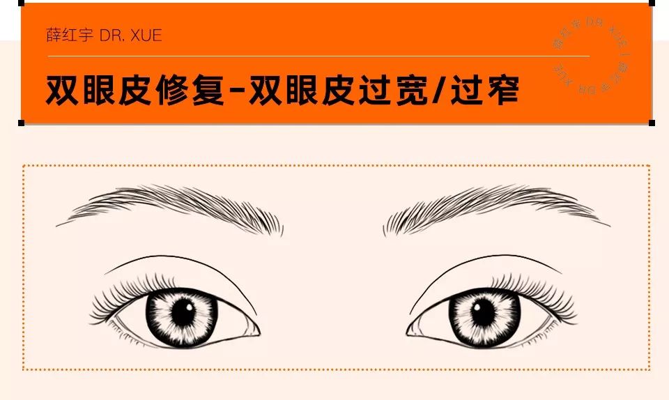 双眼皮整形修复,潘贰双眼皮修复