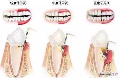 牙根暴露牙龈萎缩需要拔牙吗,牙龈萎缩牙根暴露怎么办
