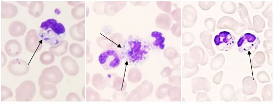 艾滋携带者的血常规,血常规可以发现艾滋么