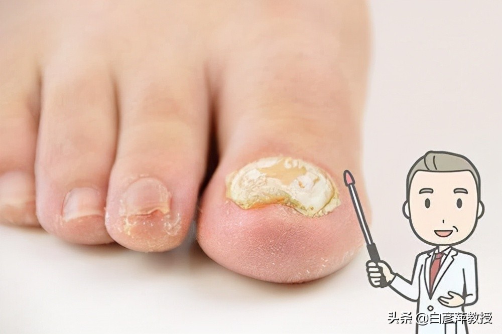 灰指甲是真菌怕晒吗,灰指甲一定是灰色的吗