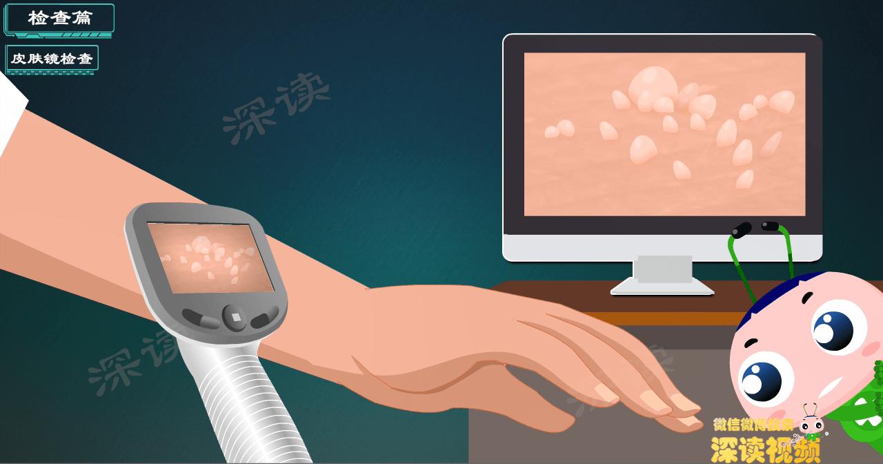 液氮冷冻治疗尖锐湿疣没感觉,液氮冷冻治疗尖锐湿疣注意事项