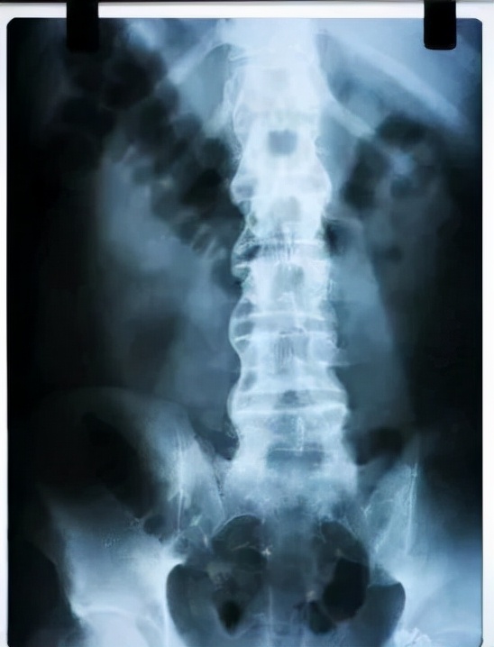 强直性脊柱炎怎么区分中轴和外周,脊柱关节炎和强直性脊柱炎区别