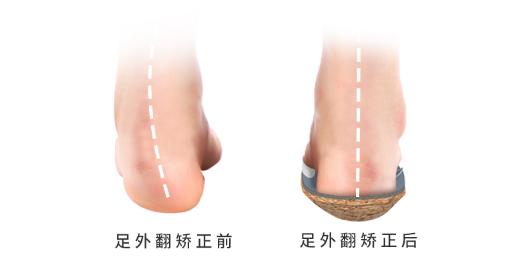 怎么让高足弓变正常足弓,足弓如何矫正