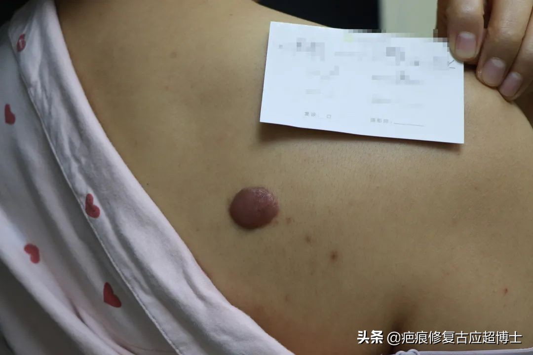 背部瘢痕疙瘩怎么去除,肩膀瘢痕疙瘩怎么食疗