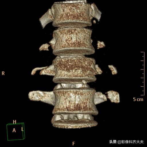 骨折的影像学检查及各自的优势,骨折的影像学愈合标准