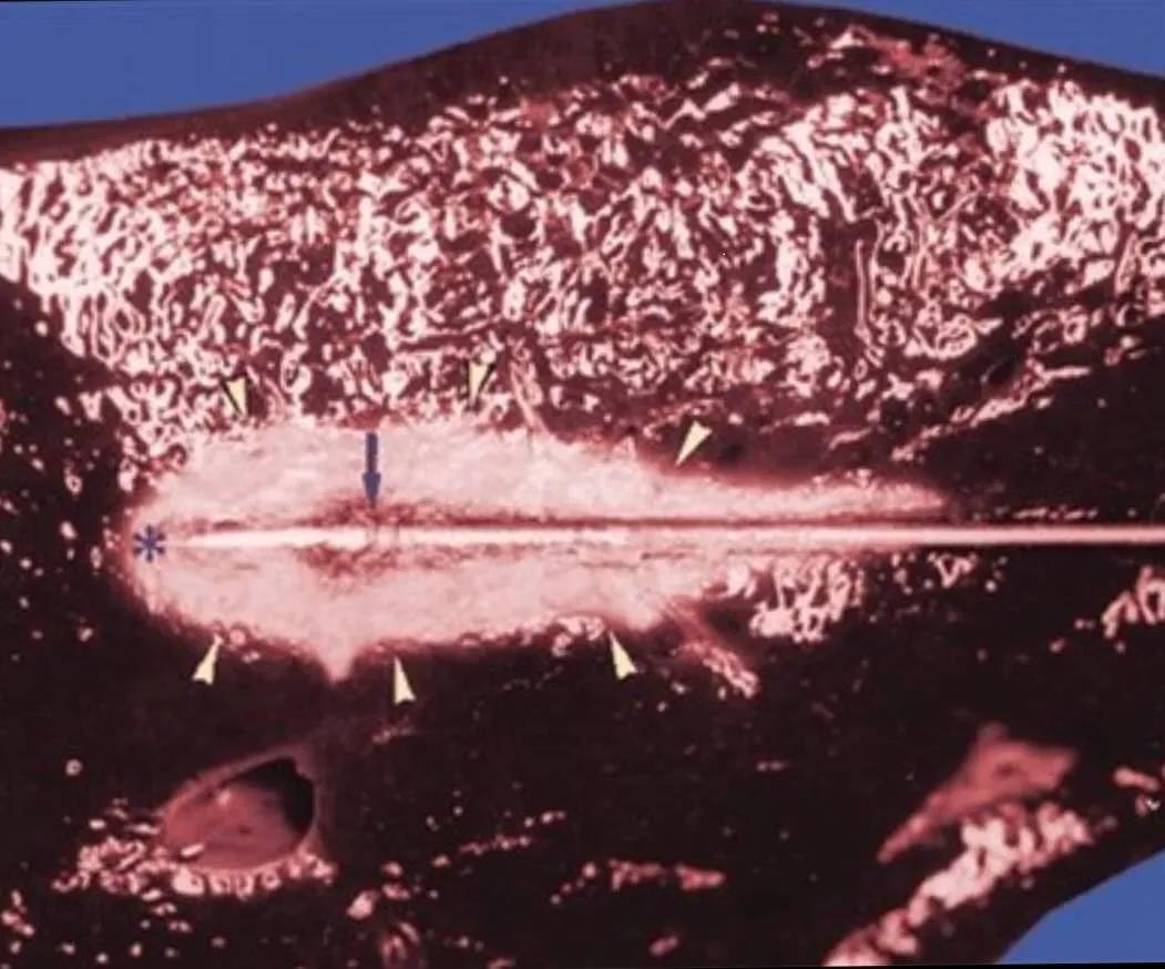 120万一针治疗肿瘤,肿瘤免疫针多少钱一针