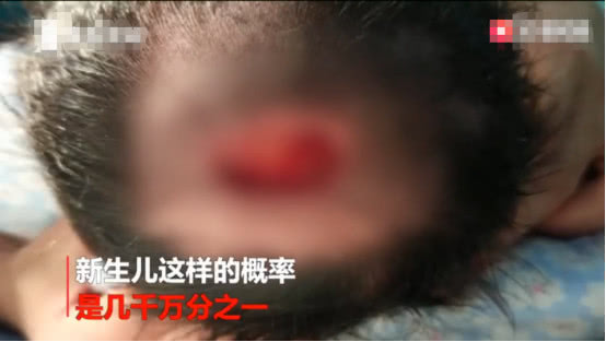 新生儿罕见现象,新生儿天生头皮缺失