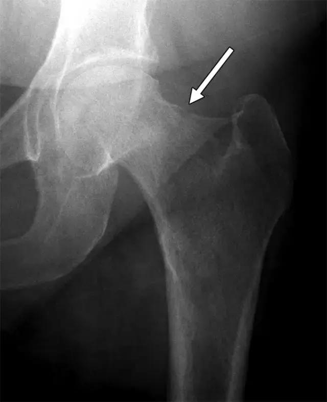 骨折处出现麻痹感,骨折跟精神状态有关