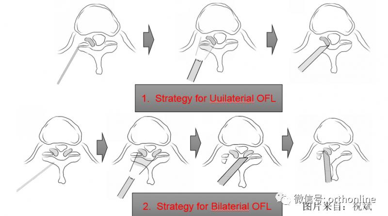 胸椎怎么做微创,脊柱内镜微创操作流程