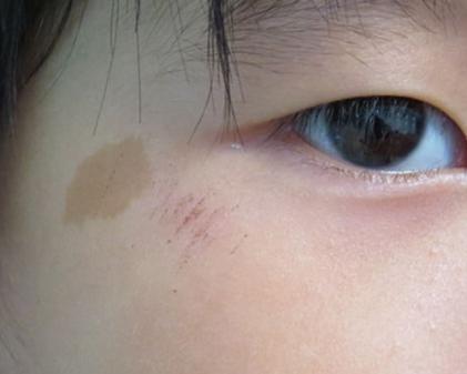 婴儿胎记激光治疗,新生儿胎记最佳治疗