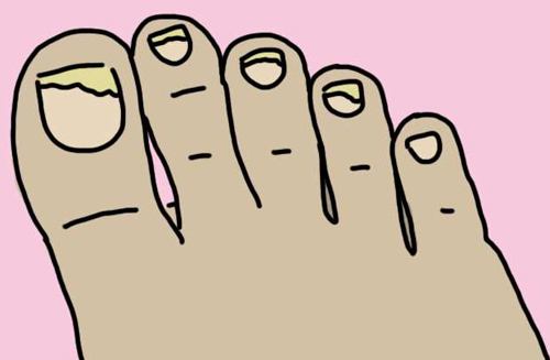 手上灰指甲早期自愈最快的办法,灰指甲不弄会怎么样