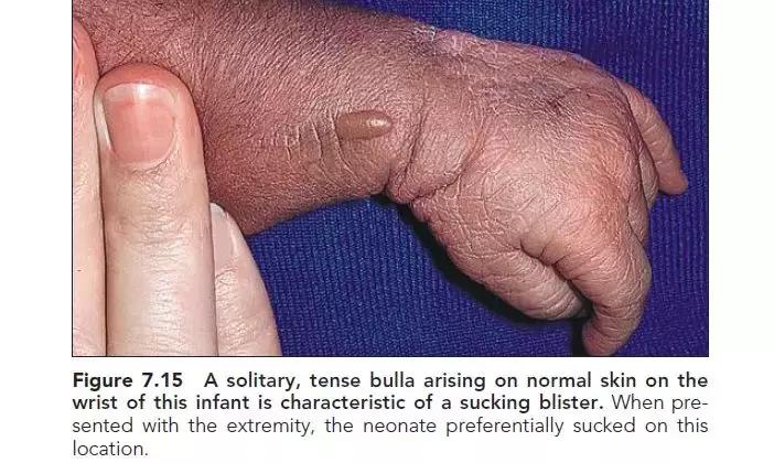 新生儿皮肤问题大全一览表,新生儿常见八大皮肤问题