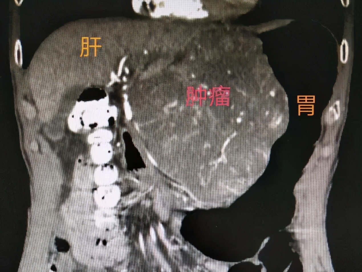 胃肠间质瘤典型病例诊治与解析,桂林医学院附属医院肠胃科
