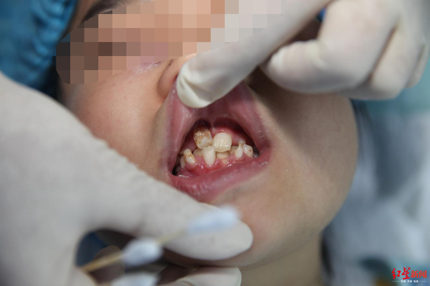 13岁女孩鼻窦炎能治好吗,女童13岁鼻窦炎不治会怎么样呢