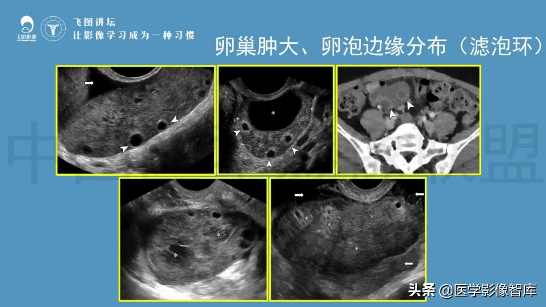 子宫解剖结构输卵管和卵巢位置,子宫附件ct影像学正常解剖表现