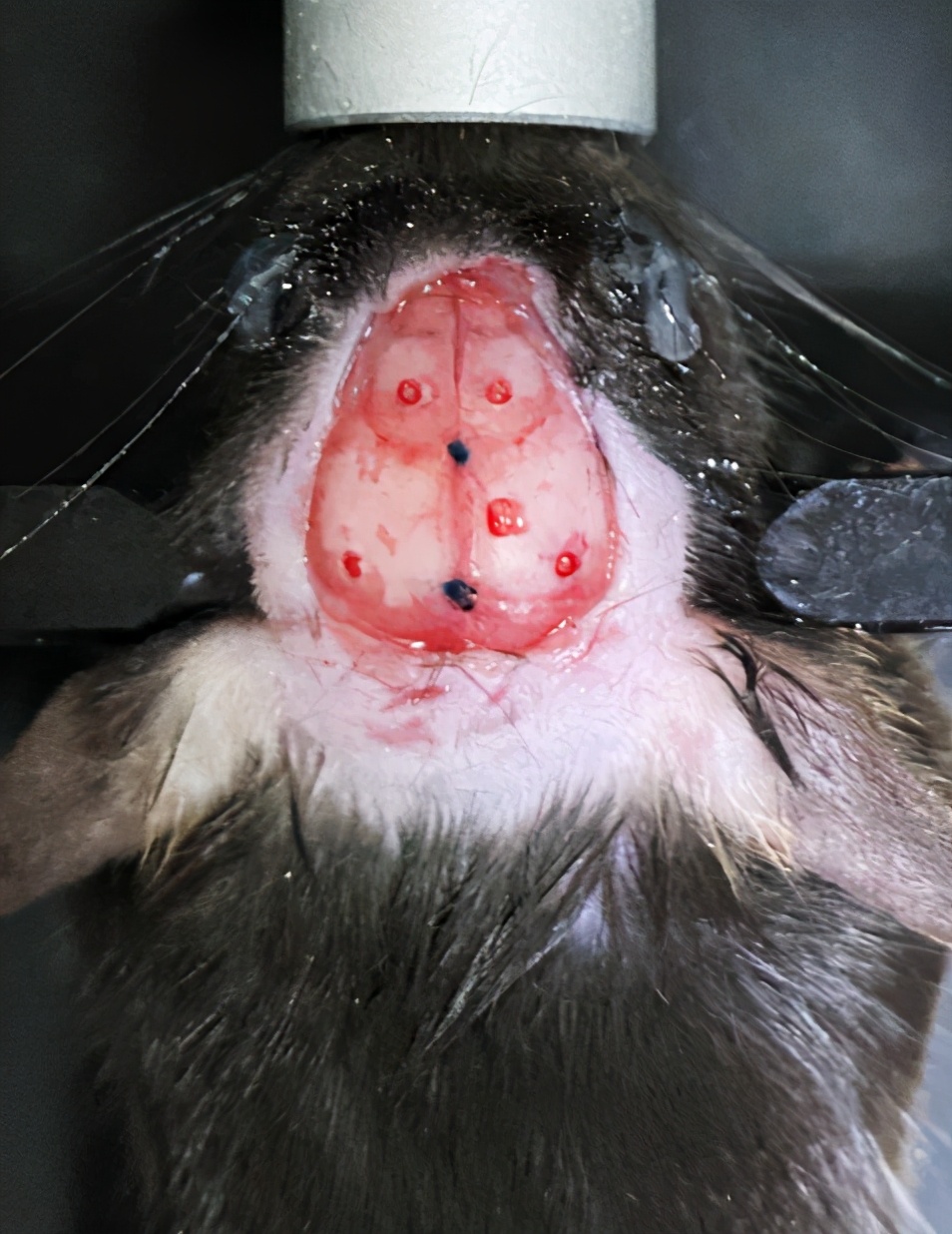 晶体植入手术的分享,可调微丝阵列电极