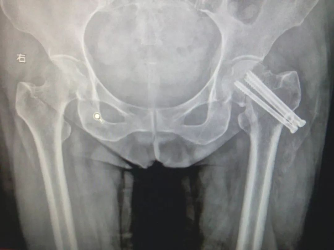 老人髋部骨折多长时间恢复到正常,老年人骨折无法固定怎么办