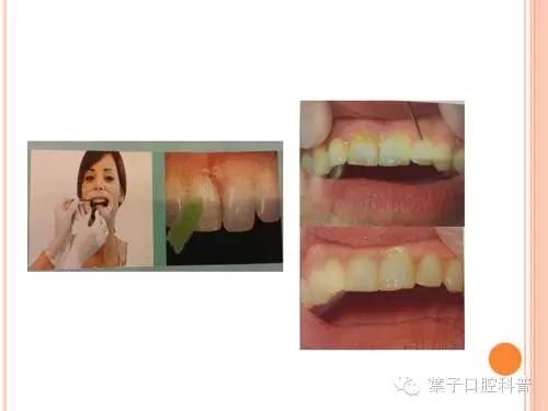 牙齿涂氟小知识,有氟牙可以涂氟吗