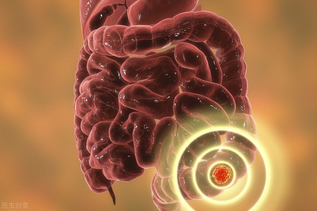 直肠管状腺瘤严重吗属癌吗,直肠管状腺瘤低级别