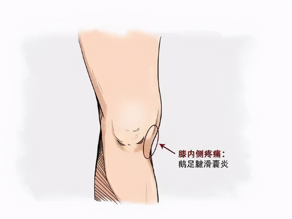 膝关节疼引起的跟腱炎,膝关节痛门诊主诉