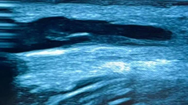 微创北京积水潭医院,肾内科血管造瘘