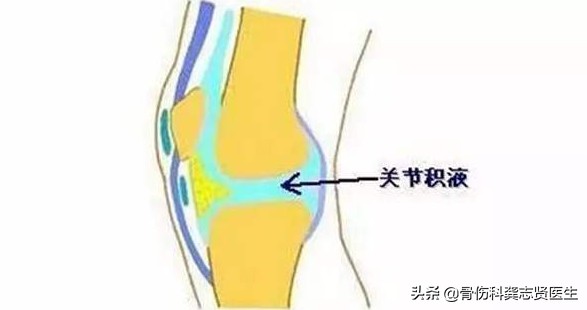 膝关节痛是小事再不重视就晚了,辟谣半月板三度损伤