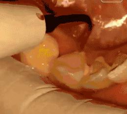 洗牙为什么三甲会更贵,洗牙不赚钱为什么医生还建议洗牙