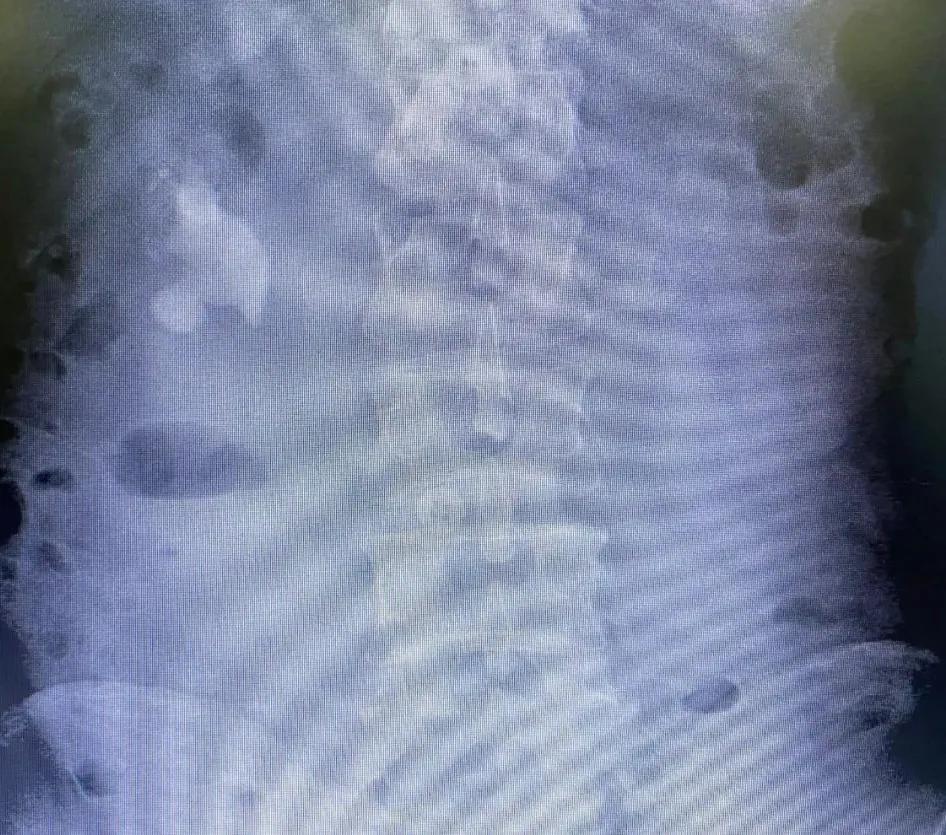 输尿管软镜碎石术安全么,输尿管软镜碎石术难受吗