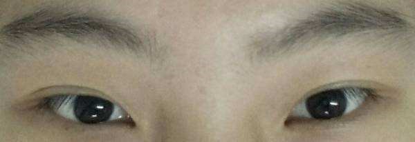 内眼角和外眼角哪个好恢复,内眼角和外眼角哪个回缩厉害