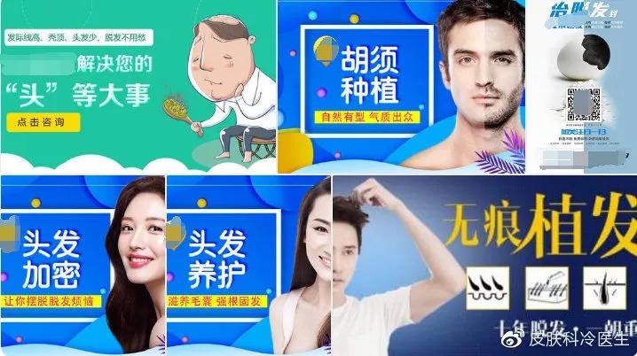 移植毛发真的有效吗,毛发移植能维持多久