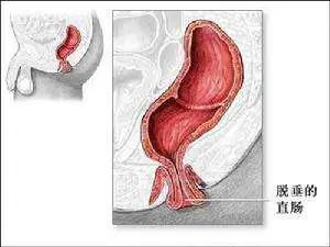 大便排不尽老是肛门堵咋办,肛门神经紧张大便不尽怎么治疗