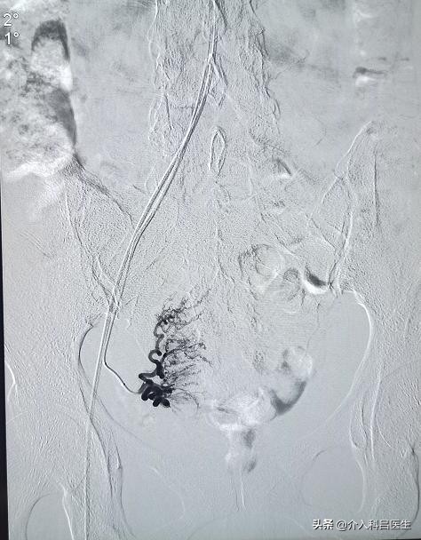 前列腺增生介入治疗效果好不好,治疗前列腺增生尿频