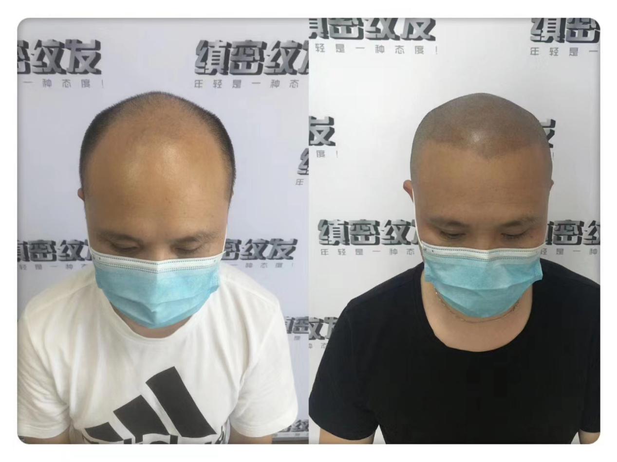 面对脱发如何自救,脱发的人自卑怎么调整心态