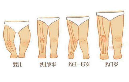 膝内翻与膝外翻的区别儿童,3岁小孩膝外翻常见吗需要治疗吗