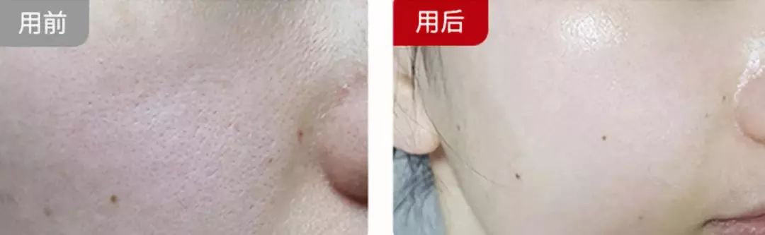 李湘直播间推荐祛痘,李湘推荐美容仪小v脸