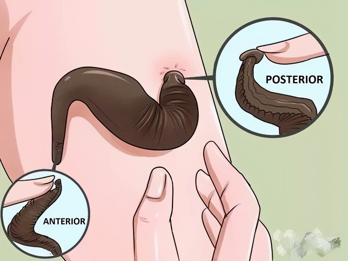 被蚂蟥钻身体里到底有多恐怖,蚂蝗能进入人的大脑里吗