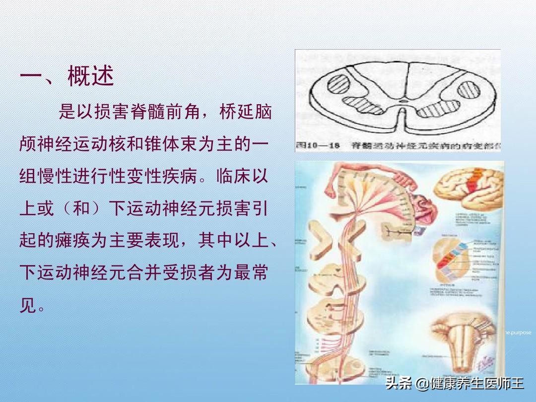 人体健康之运动神经元病,运动神经元病的锻炼方法