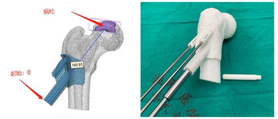 3d打印人工股骨头关节最新技术,3d打印人工骨再造脚趾